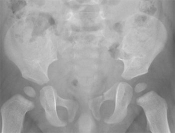 Iliac wing fracture, left