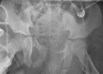      * *
L: undisplaced superior ramus # R (Torode & Zeig III)   R: displaced R and L inferior and superior rami# (Torode&Zeig III) 
