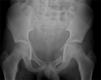 Fracture near left SI joint and fracture through left superior and inferior pubic rami