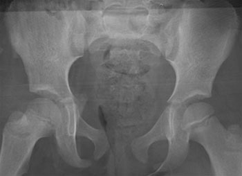 Torode IV injury with pubic diastasis and SI joint disruption
