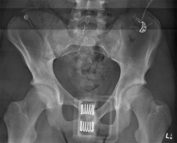 Lateral Compression fracture with fracture through right Iliac wing and the right pubic rami (obscured by pelvic binder)