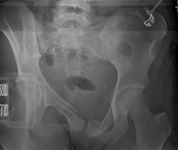 Another Lateral Compression fracture with diastasis right SI joint, fracture left superior and inferior SI joints