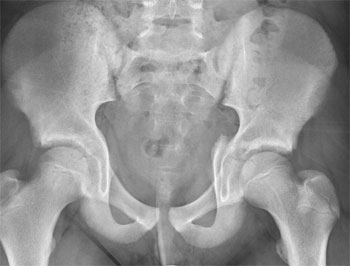 Fracture of left acetabulum with intact pelvic ring. 