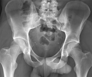 More subtle non-displaced left acetabular fracture after minor trauma