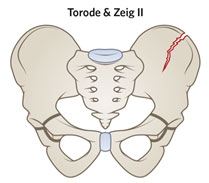 Torode & Zieg II