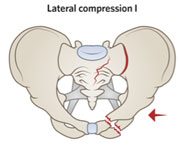 Ramus fracture with sacral ala compression fracture