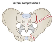 Ramus fracture with posterior iliac fracture-dislocation