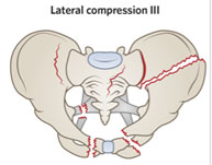 Lateral compression fracture with contralateral anterior compression pattern