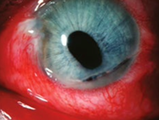 A close up of a person's eye  Description automatically generated