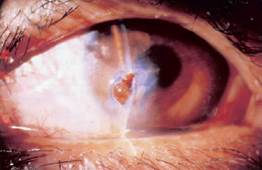 Clinical Practice Guidelines : Penetrating eye injury