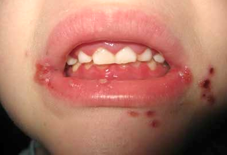 HSV Gingivostomatitis image 1