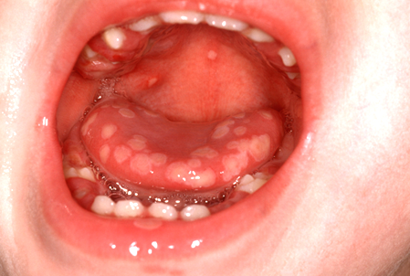 HSV Gingivostomatitis image 2