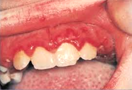 HSV Gingivostomatitis image 3