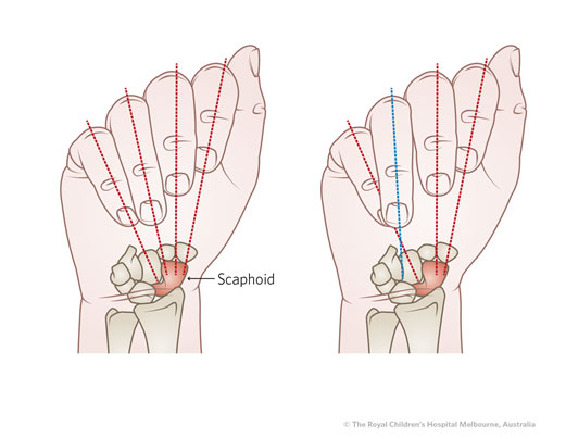 n open wound over the dorsal aspect of the metacarpal head may suggest a fight bite