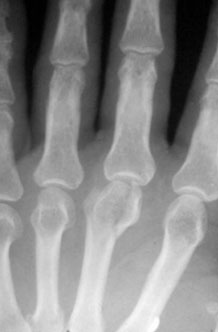 Metacarpal Head Fracture