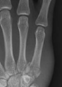 Metacarpal Base Fracture
To better appreciate any dorsal subluxation in these injuries, a lateral or oblique view should be examined