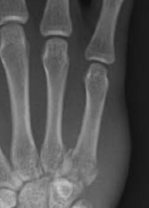 Metacarpal Base Fracture
To better appreciate any dorsal subluxation in these injuries, a lateral or oblique view should be examined