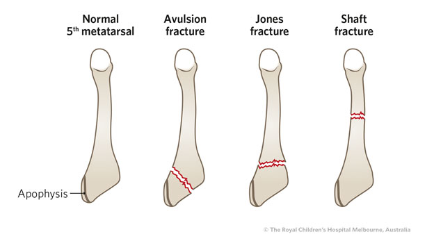 Fractures of the fifth metatarsal