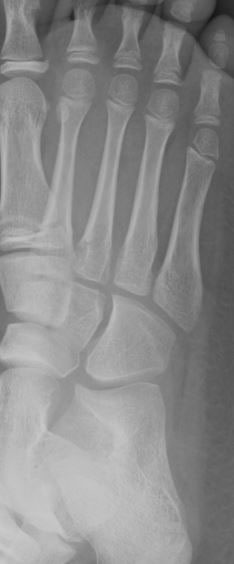 metatarsal fracture boot