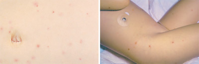 petechiae on the torso and legs of a child