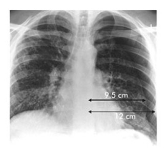 pneumothorax_xray