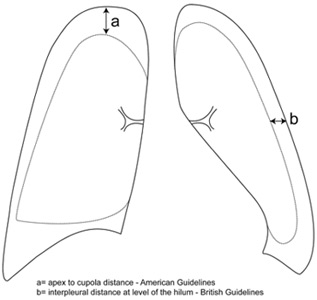 pneumothorax_xray2