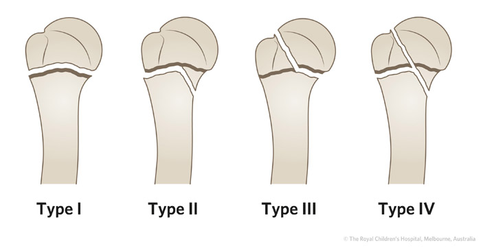 Clinical Practice Guidelines Proximal Humeral Fractures Emergency 