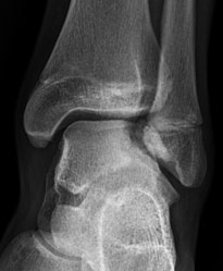 osteochondral fracture of 
talar dome_1