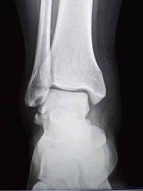 fracture of lateral process