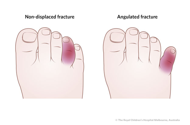 Broken Toe: Symptoms, Causes, Diagnosis, Treatment, and More - wide 2