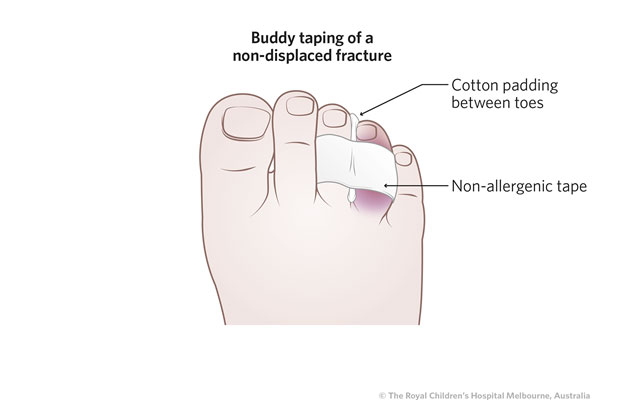 Pediatric Medical Boot - Foot Fracture, Ankle Sprain, Broken Toe | Child or  Toddler