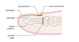 Seymour fracture_1