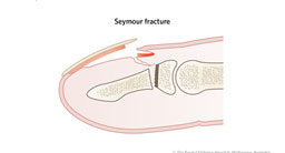 Seymour fracture_2