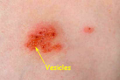 Eczema - herpes pic