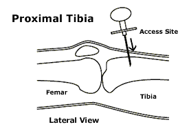 intraosseous Needle Insertion 1