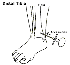 intraosseous Needle Insertion 1