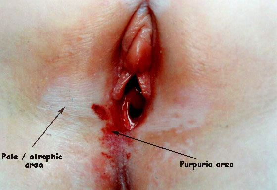 Lichensclerosis