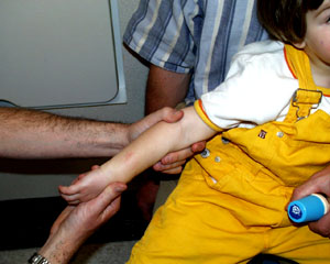 over_pronation