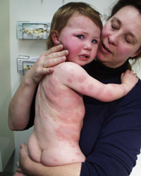 Blotchy rash typical of urticaria