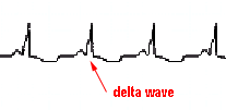 dleta wave