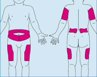 Printable Insulin Injection Site Chart