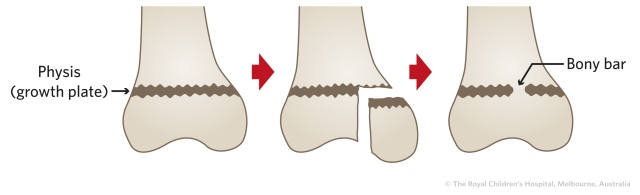 figure11_femoral