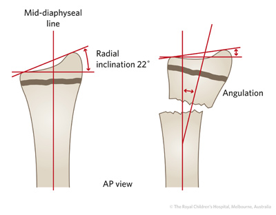 figure27a_fracture