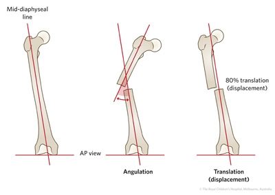 figure27b_fracture