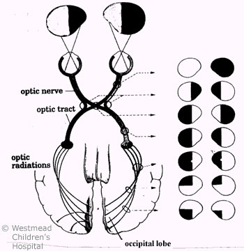 ABI Visual Field Defects KHI RCH