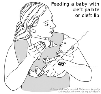 Kids Health Information : Cleft lip and palate – infant feeding