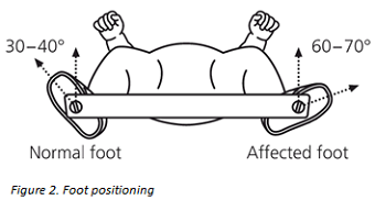 Kids Health Information Clubfoot Boots And Bar