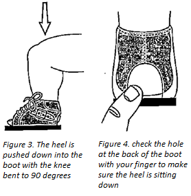 Kids Health Information Clubfoot Boots And Bar