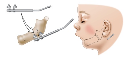 Jaw distractor pre expansion