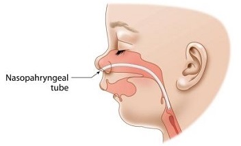 Nasopharyngeal_tube